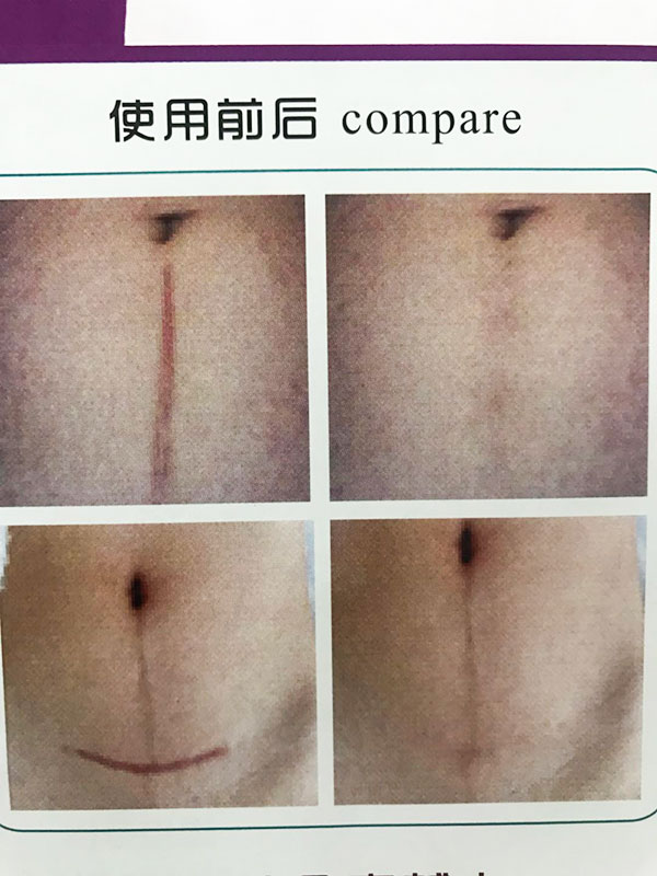 醫用冷敷貼疤痕貼